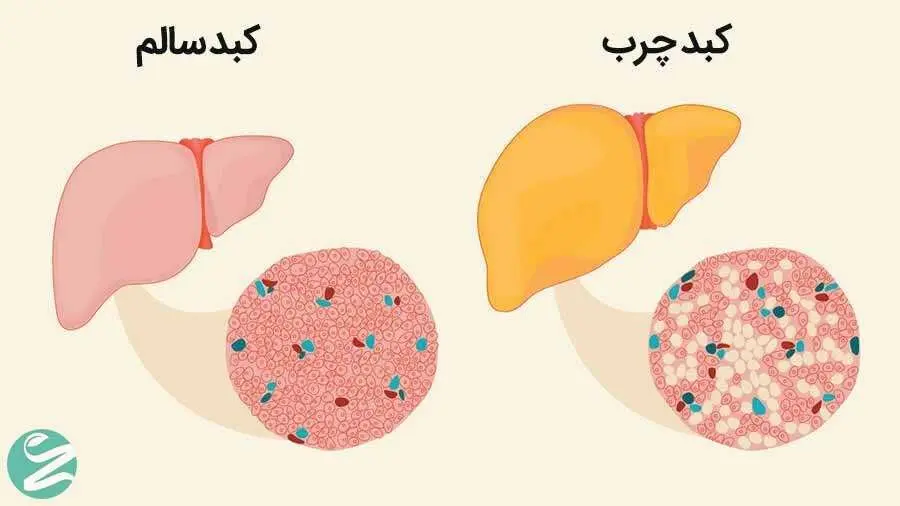 راهکار عالی برای درمان کبد چرب| برای درمان کبد چرب چه کنیم؟؟
