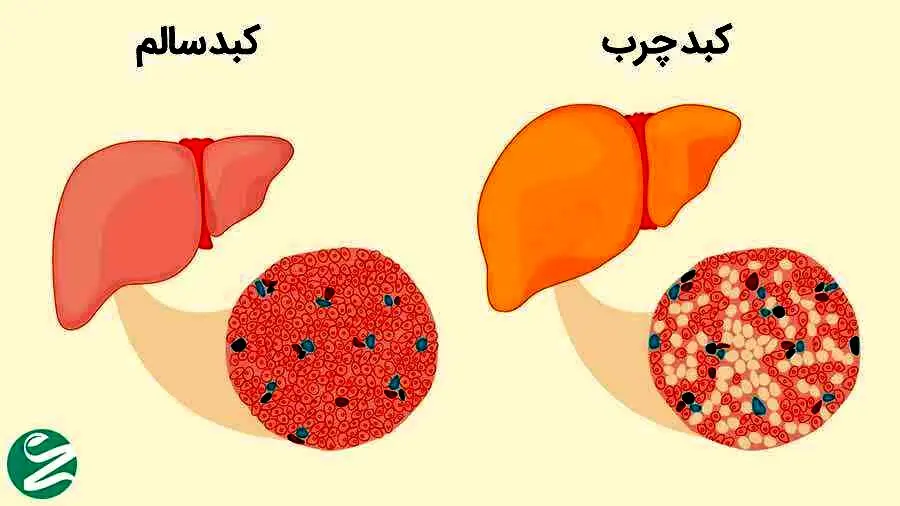 راهکار عالی برای درمان کبد چرب| برای درمان کبد چرب چه کنیم؟؟