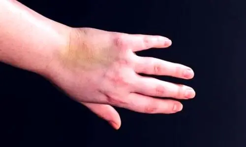 اگر بدنتان بی دلیل کبود میشه بخوانید | چه بیماری هایی باعث کبودی بدن میشود ؟