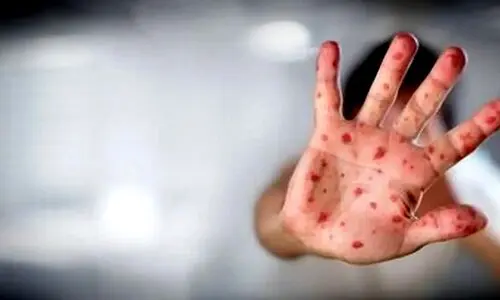 هشدار جدی : شیوع بیماری عفونی خطرناک 