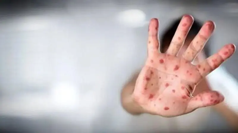 هشدار جدی : شیوع بیماری عفونی خطرناک 