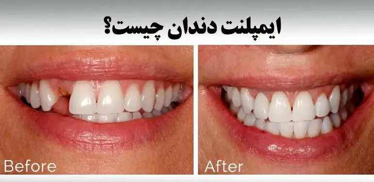 آیا دندان ایمپلنت خراب می شود ؟