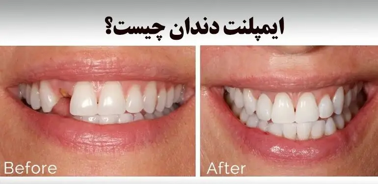 آیا دندان ایمپلنت خراب می شود ؟
