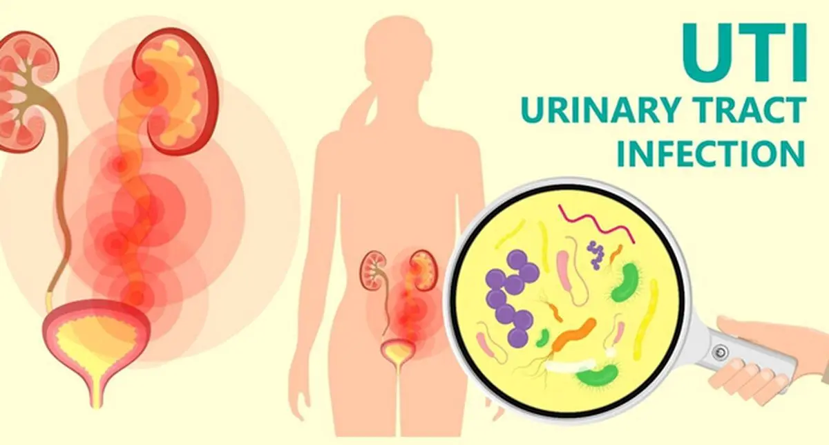 روش موثر عفونت ادراری برای مردم | با این روش خودتو درمان کن