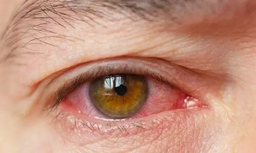 جزییات جدید از نابینا شدن ۹ نفر در بیمارستان نگاه ! | مقصران حادثه مشخص شدند ؟