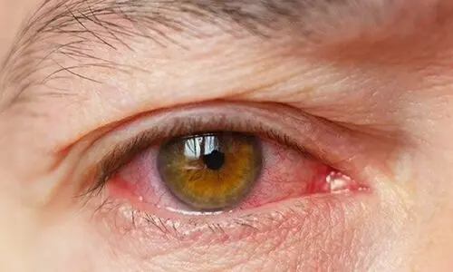جزییات جدید از نابینا شدن ۹ نفر در بیمارستان نگاه ! | مقصران حادثه مشخص شدند ؟