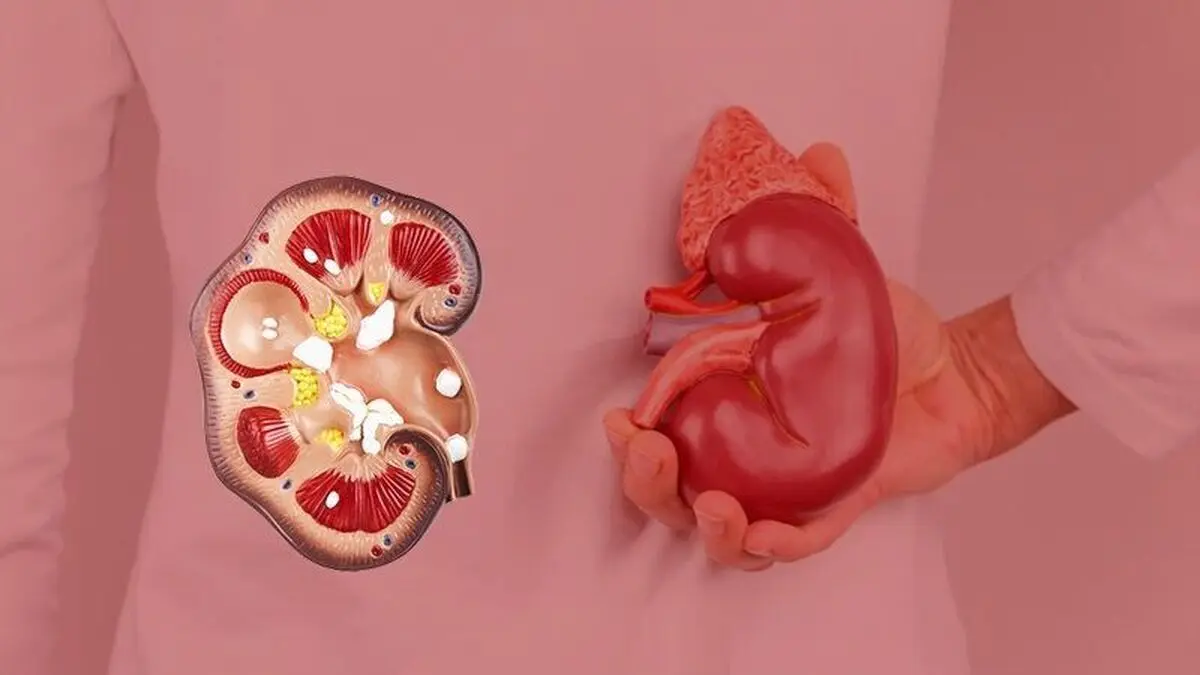 این میوه سنگ کلیه را سه سوته پودر می‌کند