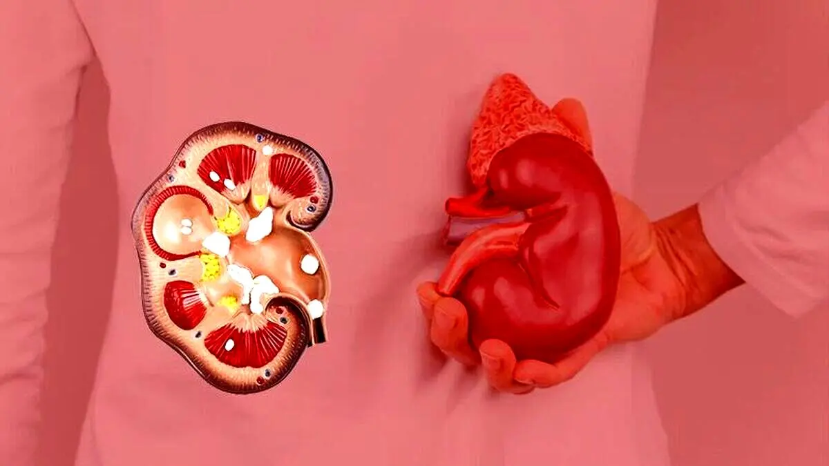 این میوه سنگ کلیه را سه سوته پودر می‌کند