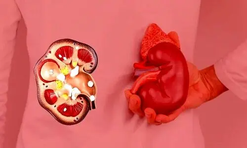 دفع قطعی سنگ کلیه + ۹ روش درمان فوری سنگ کلیه