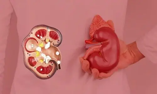 این میوه سنگ کلیه را سه سوته پودر می‌کند